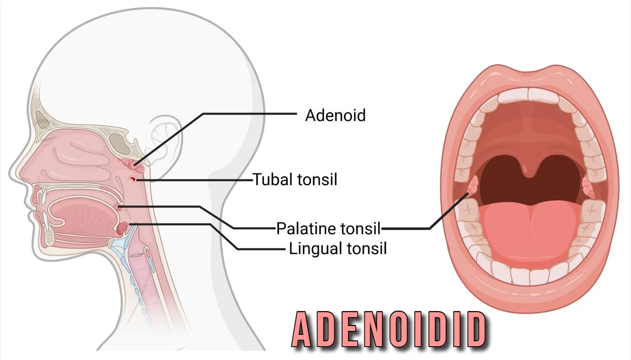 Adenoidid Lapsel & Täiskasvanul – Complete Guide to Symptoms and Treatment